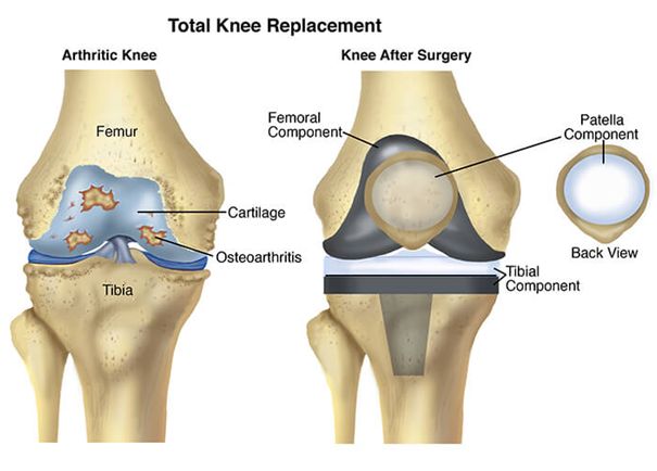 Total Knee Replacement